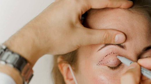 Understanding Botched Upper Eyelid Surgery - What You Need to Know