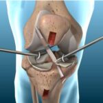 Patellar tendon ACL surgery