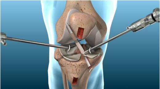 Understanding Patellar Tendon ACL Surgery: A Comprehensive Guide