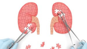 Best kidney transplant hospital in bangalore